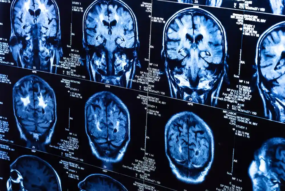 Traumatic Brain Injury Lawyer