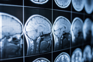 Brain scans following a brain injury
