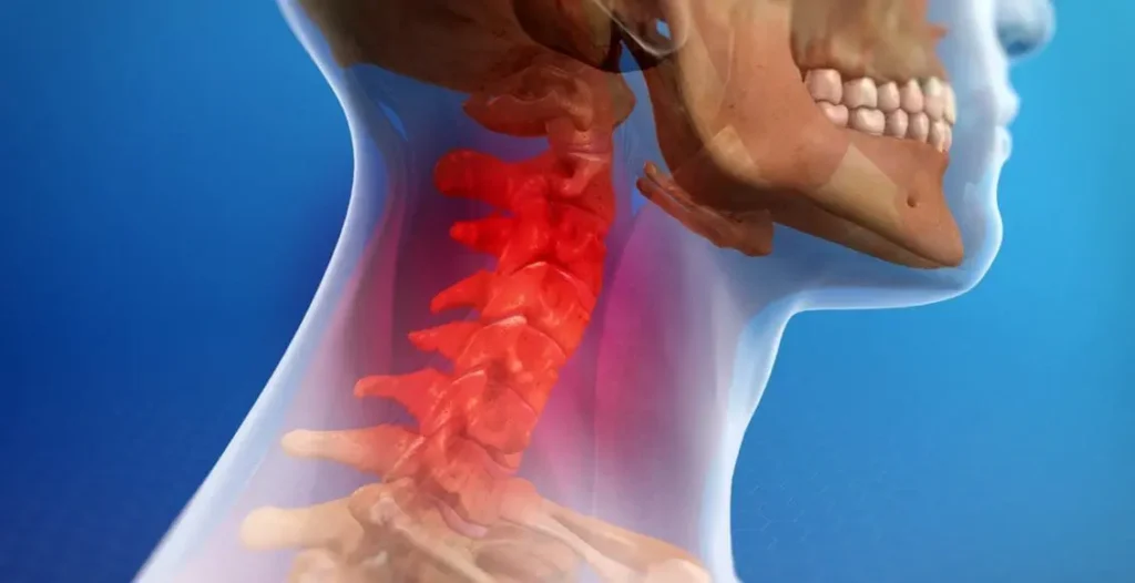 Whiplash from Car Accident Explained: Injury Symptoms, Treatment, and How to Maximize Your Claim