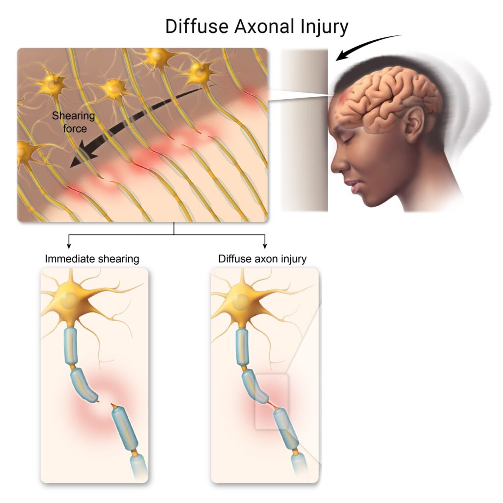 diffuse axonal brain injury life expectancy
