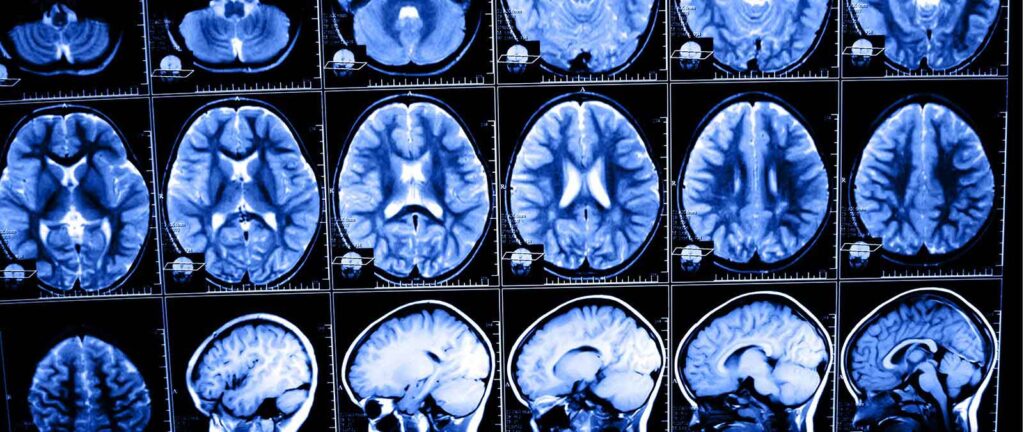 mild TBI cognitive fatigue motorcycle wreck