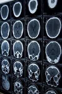 brain injury lawyer in Waterbury, CT